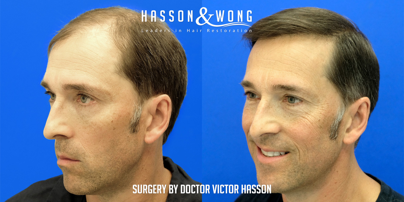 hair-restoration-surgery-before-after-65