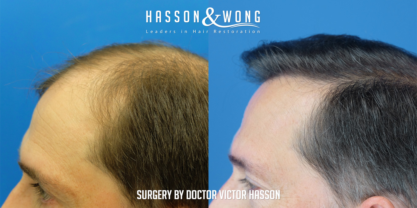 hair-restoration-surgery-before-after-65