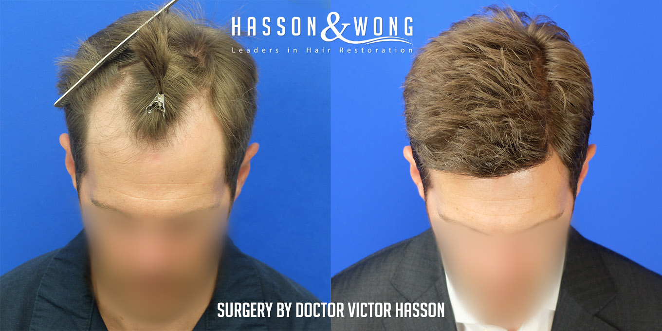 hair-restoration-surgery-before-after-40
