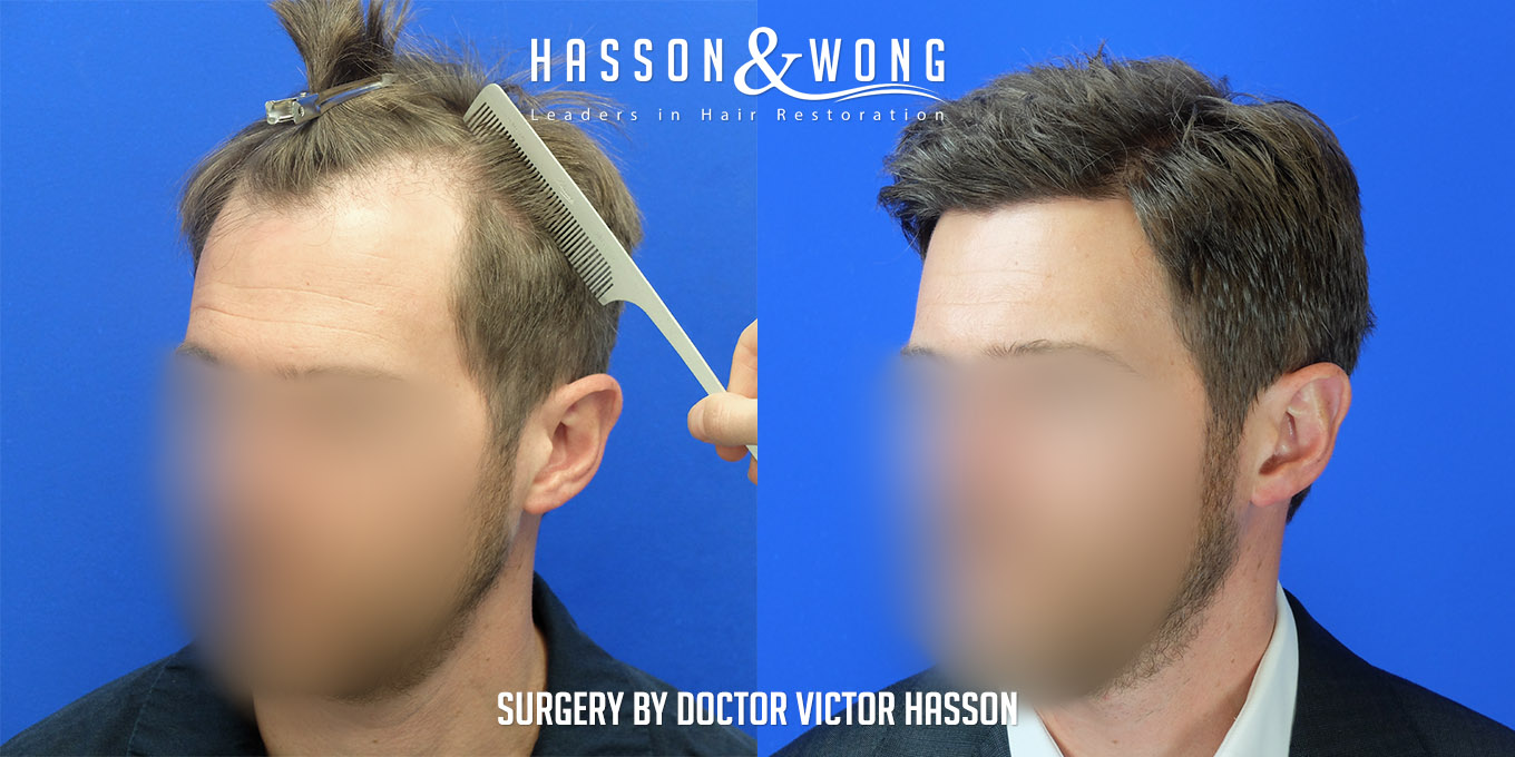 hair-transplant-surgery-before-after-403