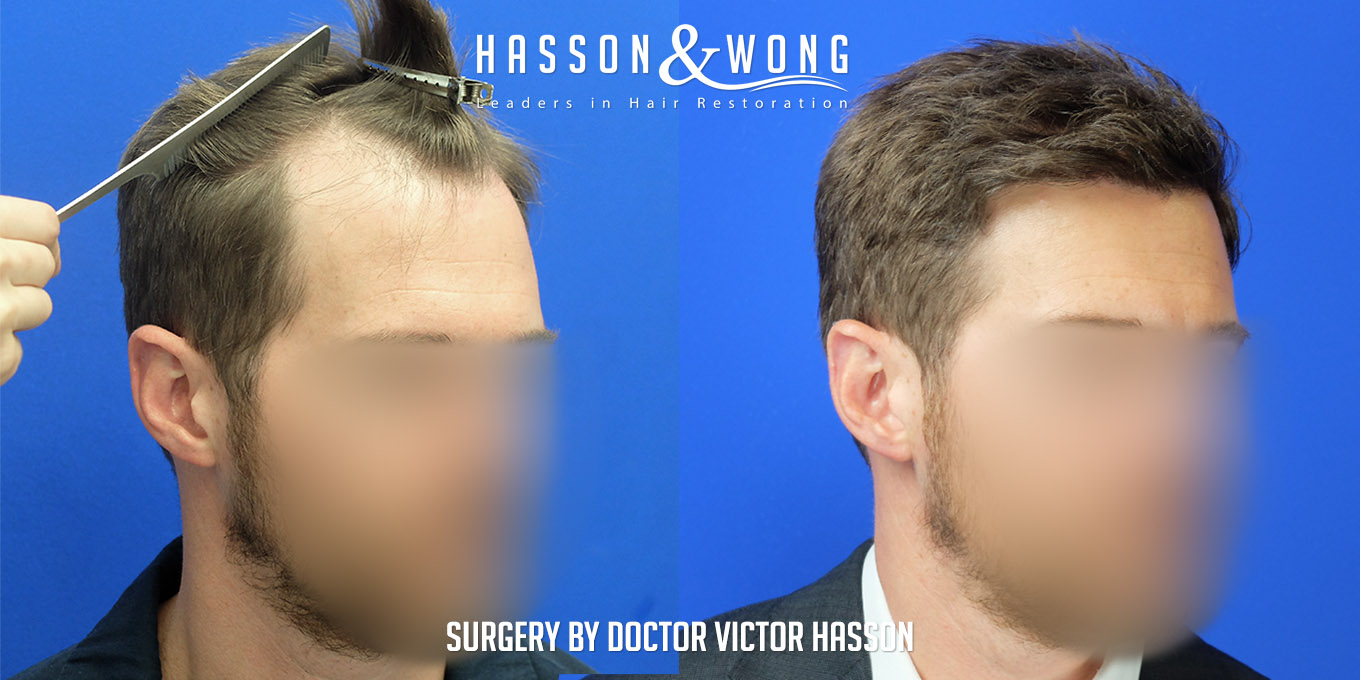 hair-transplant-surgery-before-after-403