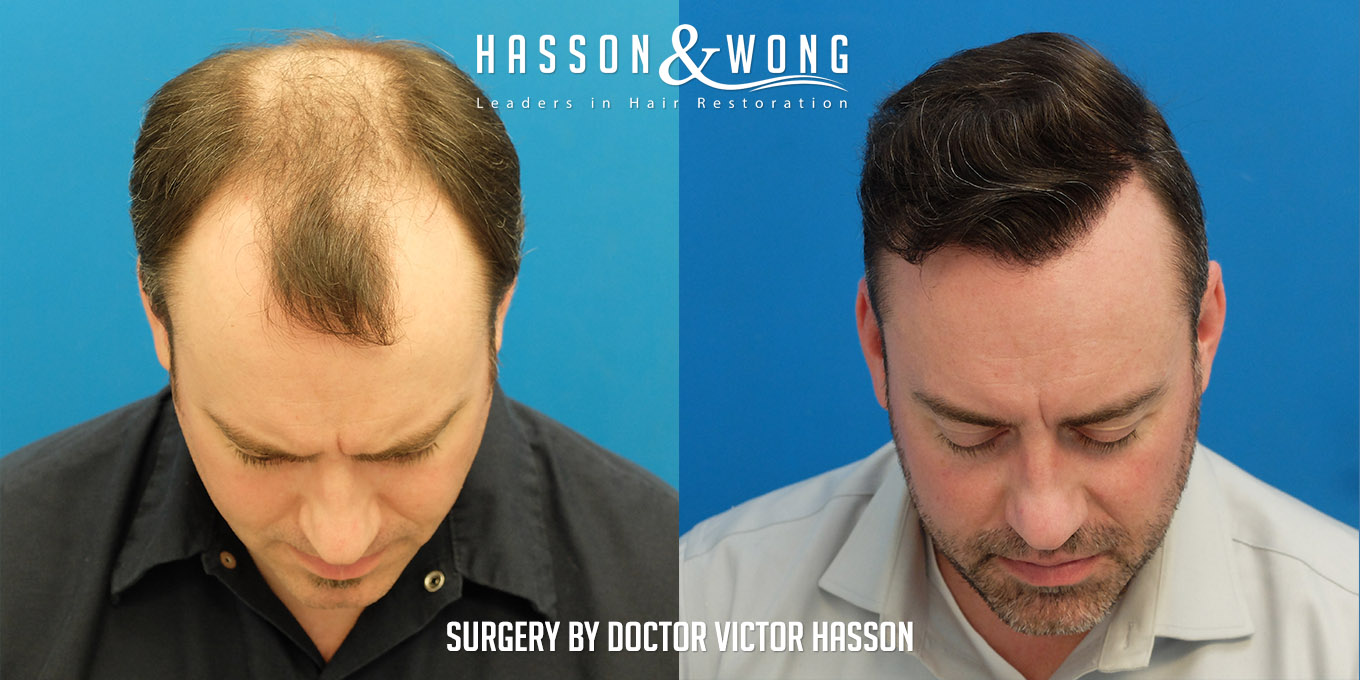 hair-restoration-before-after-7410-grafts-tilt-FUT.jpg