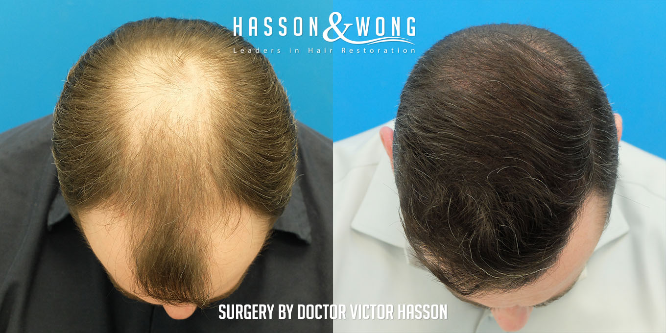 hair-restoration-before-after-7410-grafts-top-FUT.jpg