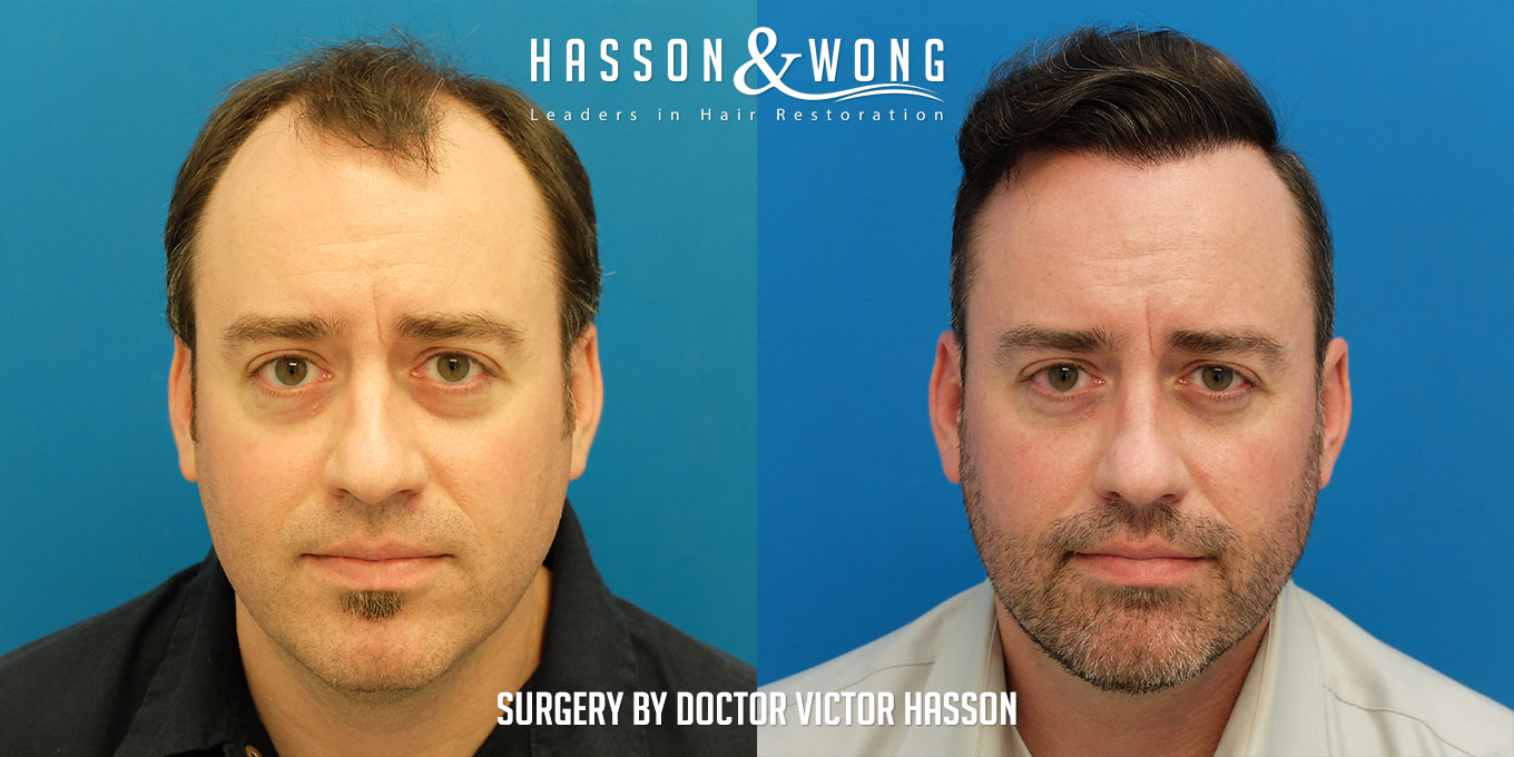 hair-transplant-before-after-7410-grafts-front-FUT.jpg