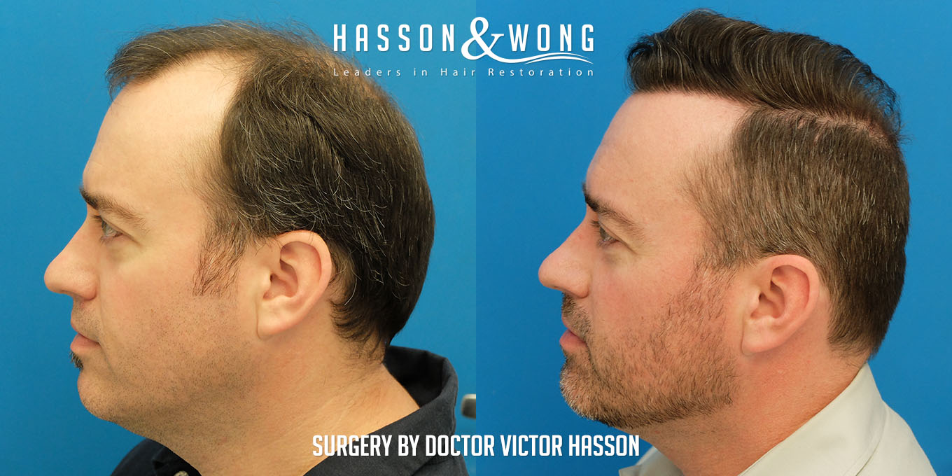 hair-transplant-before-after-7410-grafts-left-profile-FUT.jpg