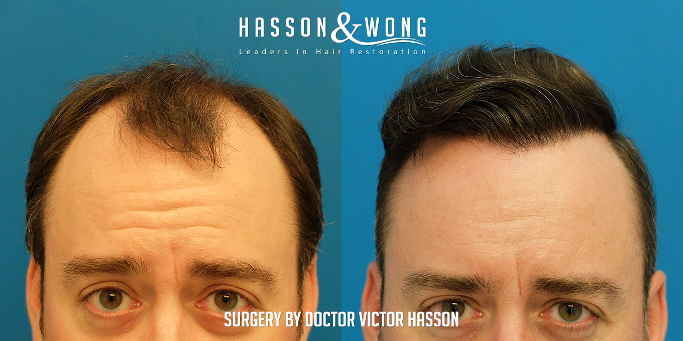 hair-transplant-surgery-before-after-7410-grafts-front-close-FUT.jpg
