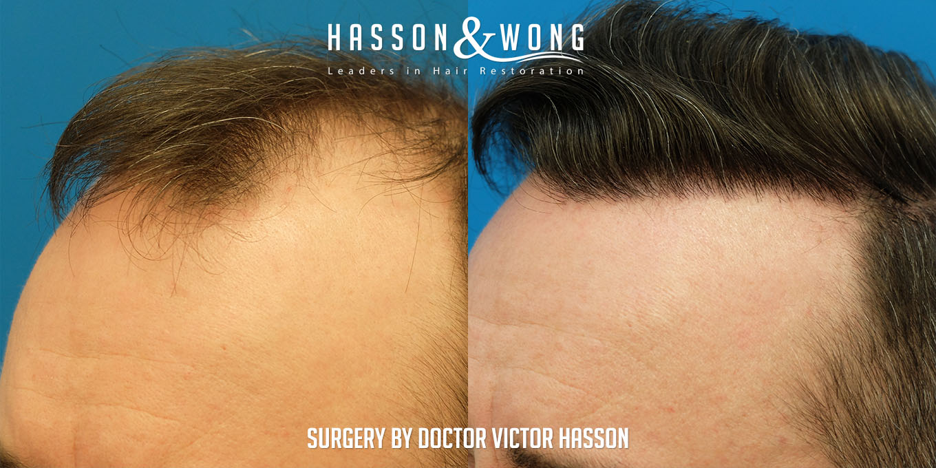 hair-transplant-surgery-before-after-7410-grafts-left-close-FUT.jpg