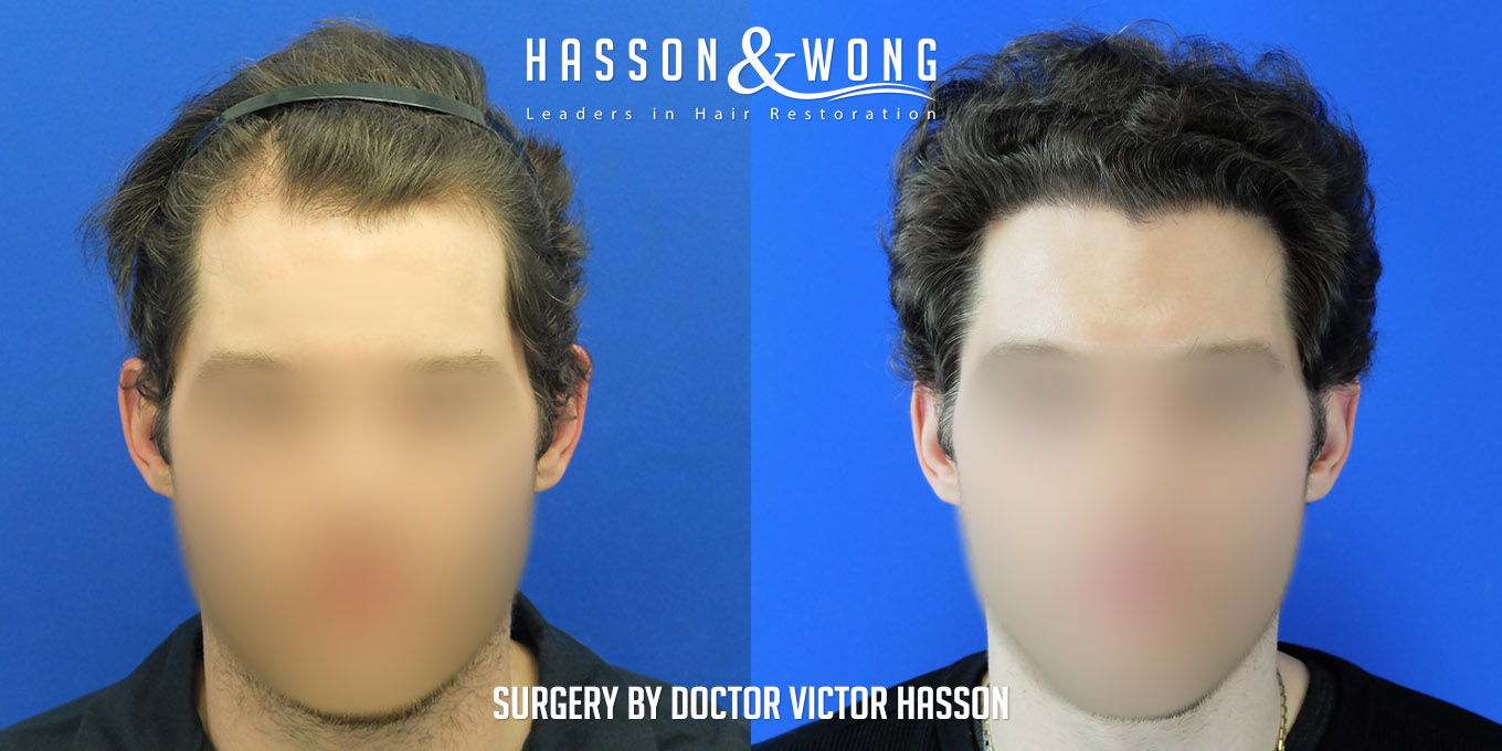 hair-transplant-surgery-after-4010-graft