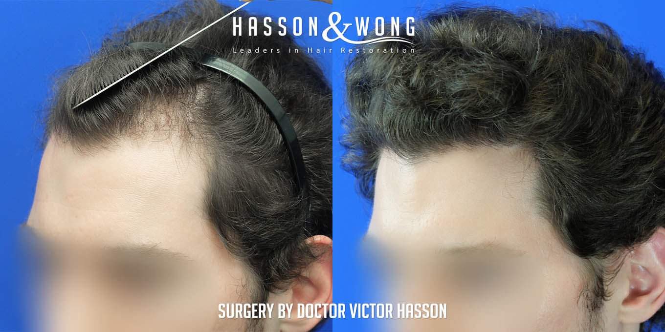 Hair Transplant with Dr. Hasson /4,010 Grafts/ FUE/ 1 Session/ 1 year  post-op | Hair loss Forum - Hair Transplant forums