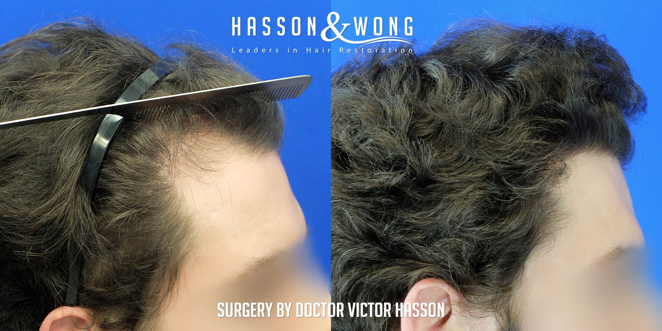 hair-transplant-surgery-after-4010-graft