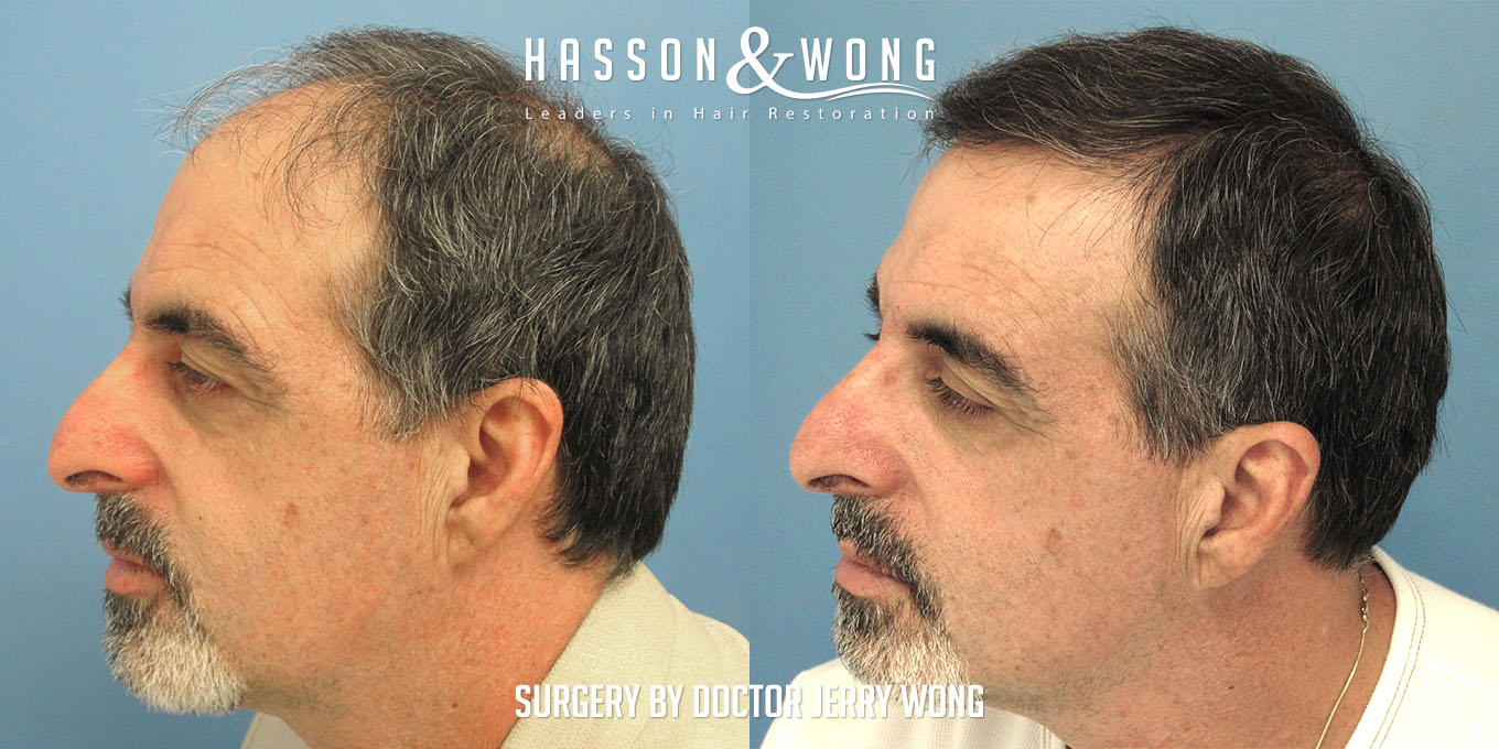 hair-restoration-before-after-5496-graft