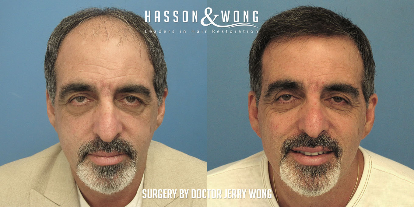 hair-transplant-before-after-5496-grafts