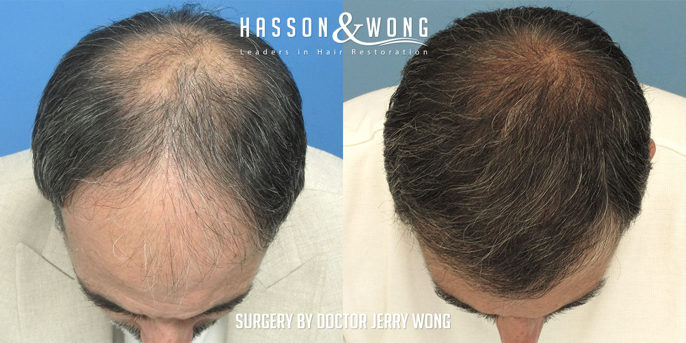 hair-transplant-surgery-before-after-549