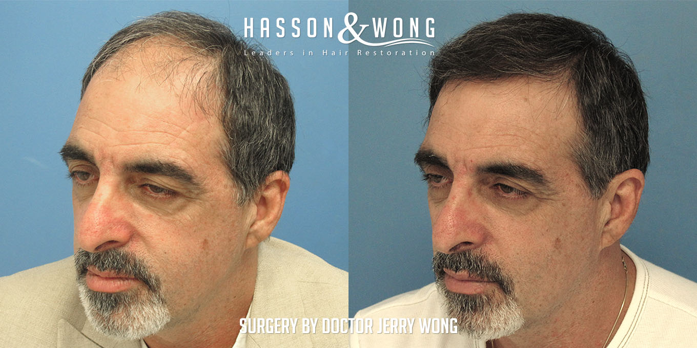 hair-transplant-surgery-before-after-549