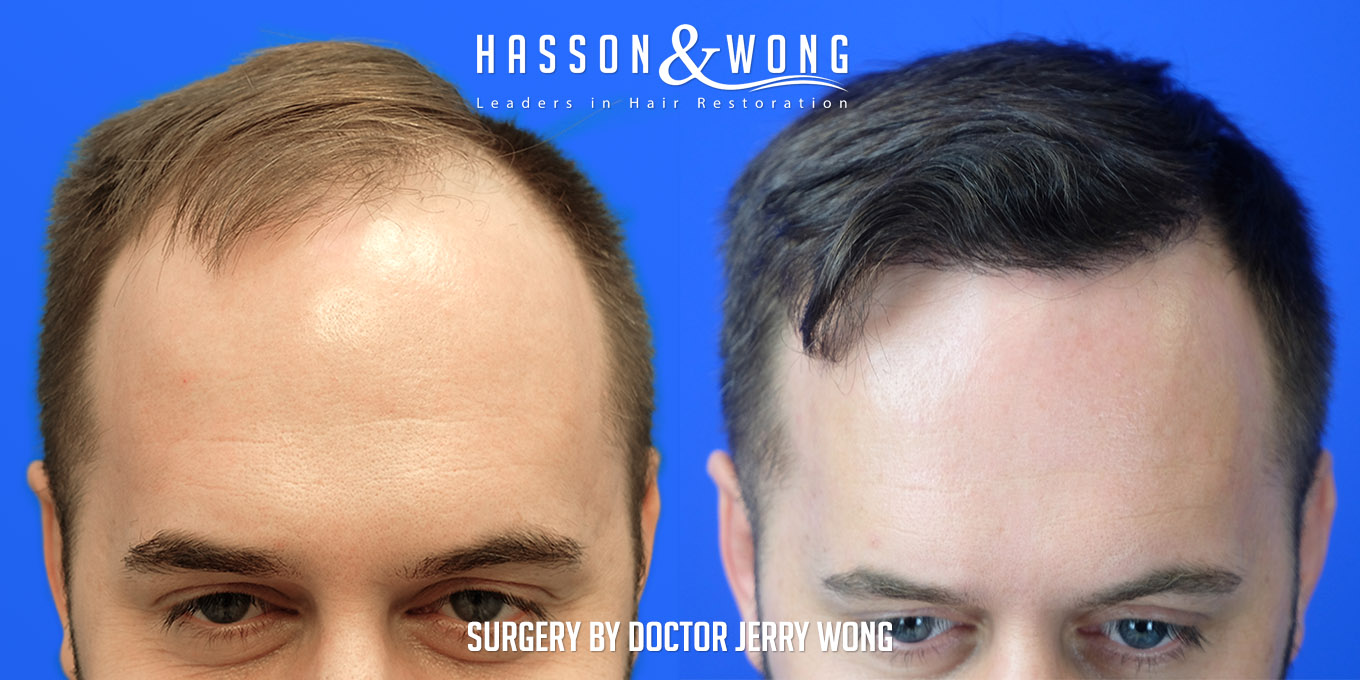 hair-restoration-surgery-before-after-36