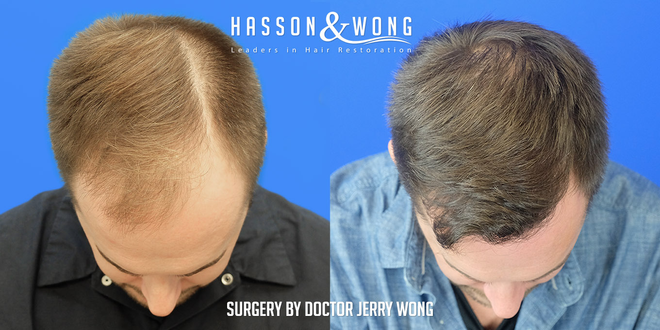 hair-transplant-surgery-before-after-365