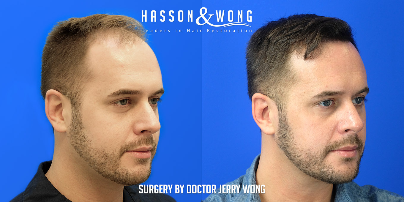 hair-transplant-surgery-before-after-365