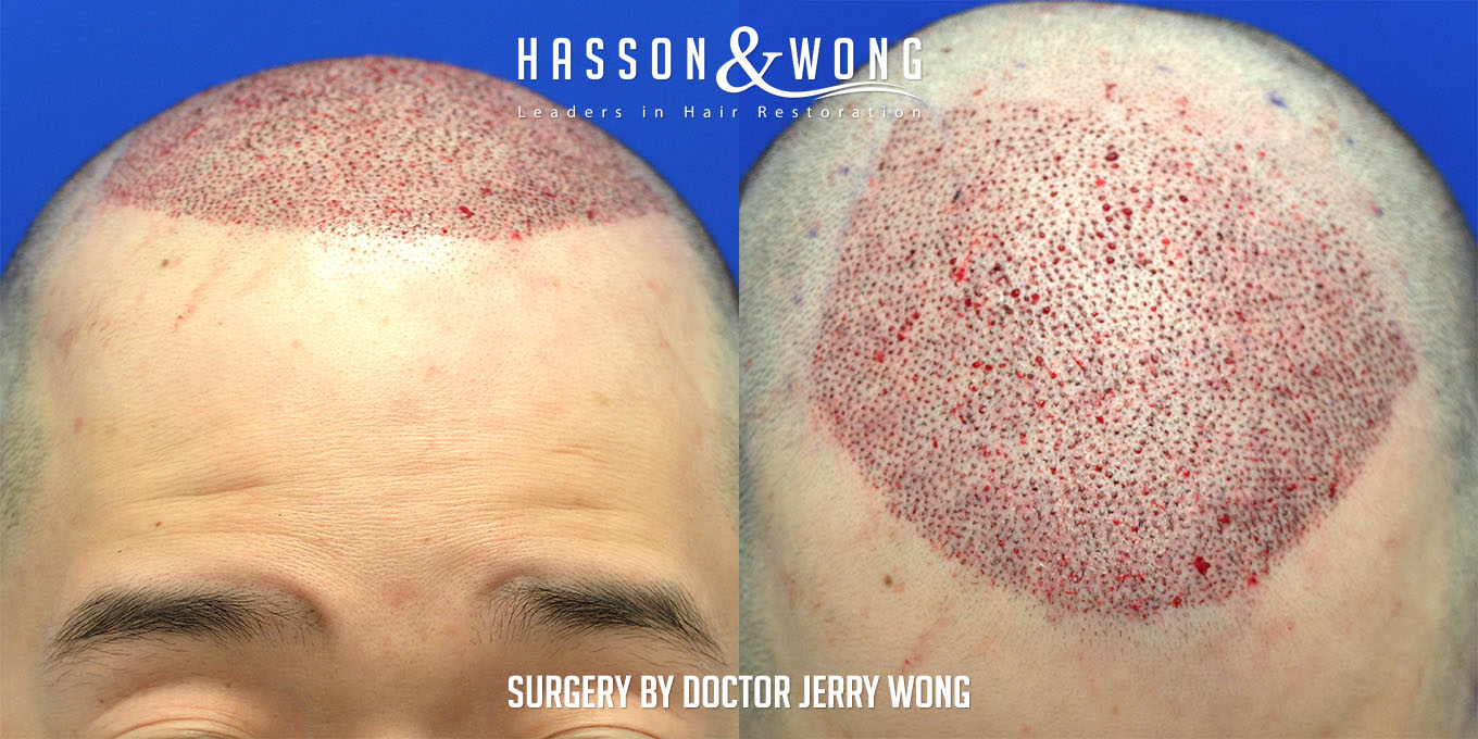 hair-restoration-surgery-before-after-36