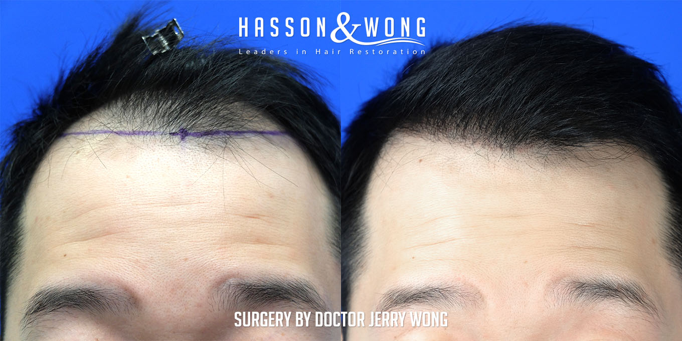 hair-transplant-surgery-before-after-250