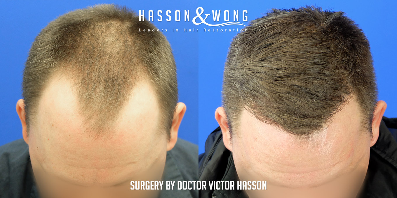 hair-restoration-surgery-before-after-30