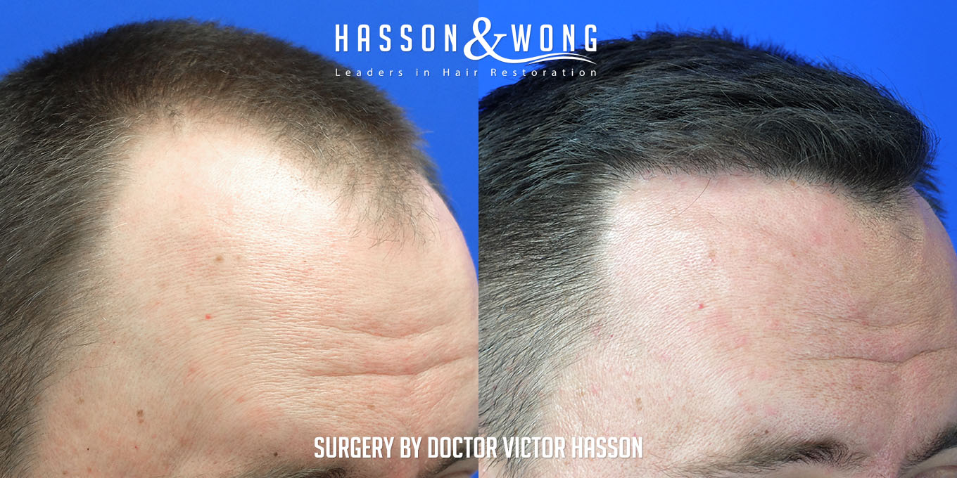 hair-transplant-surgery-before-after-305