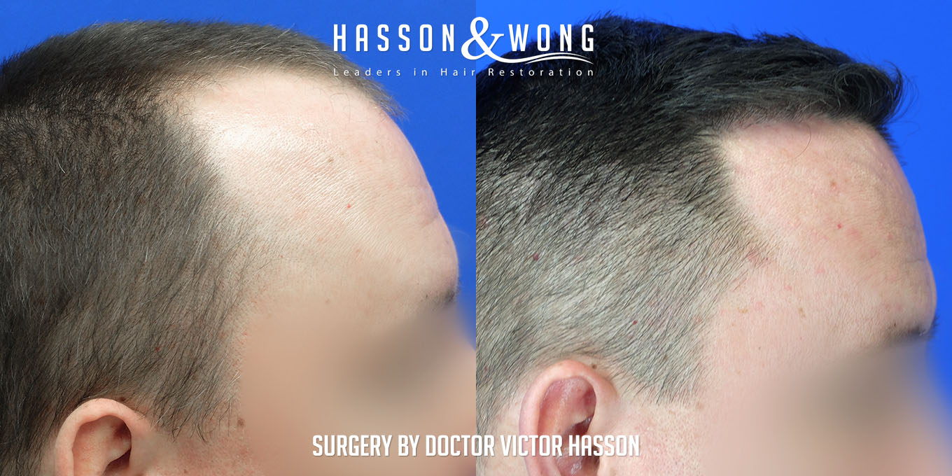 hair-transplant-surgery-before-after-305