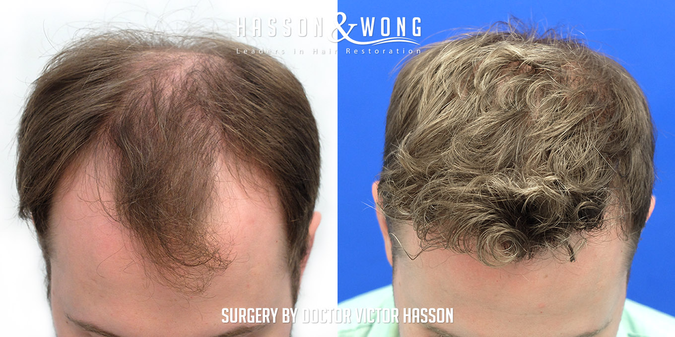 hair-restoration-surgery-before-after-58
