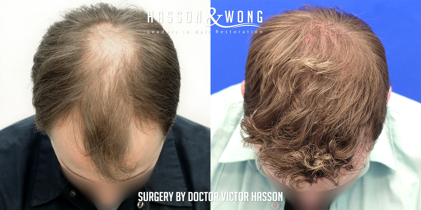 hair-restoration-surgery-before-after-58