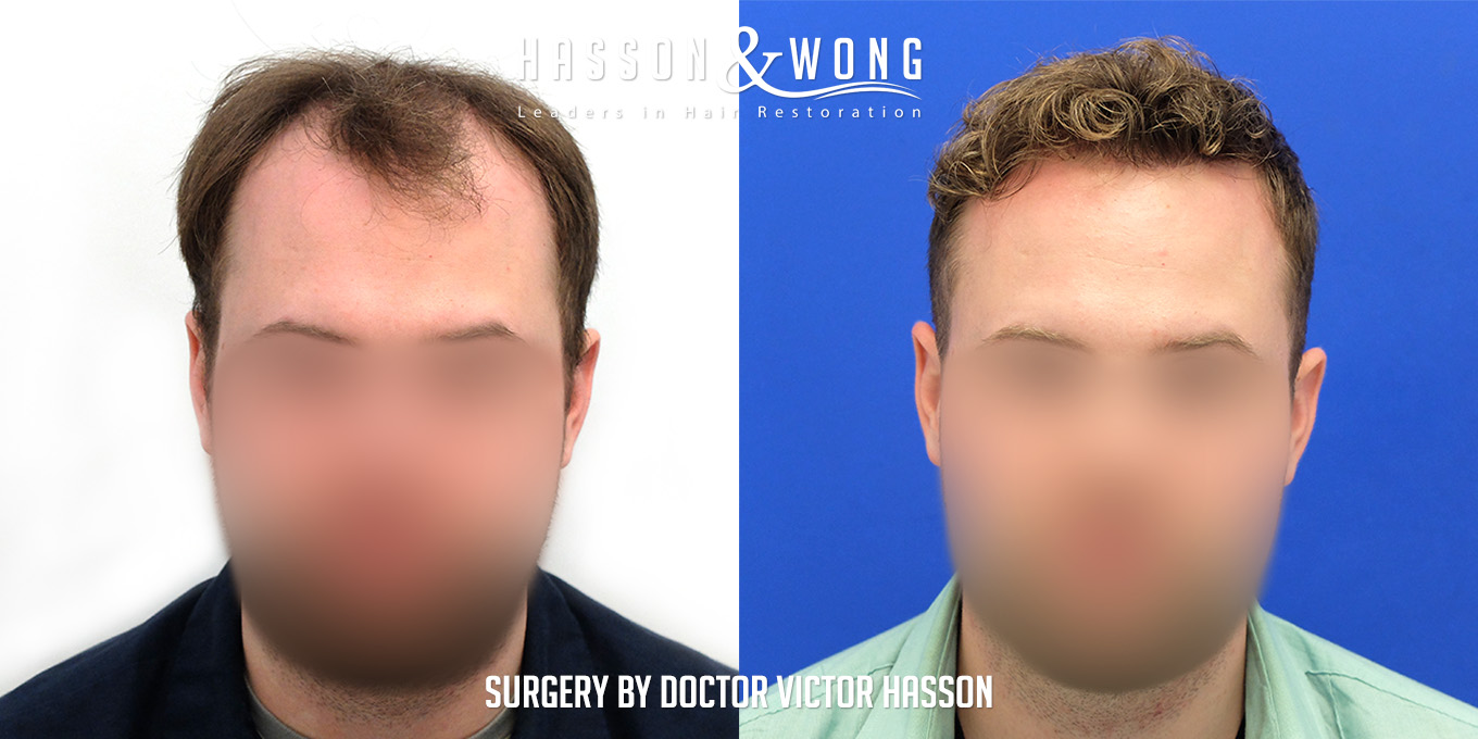 hair-transplant-before-after-5886-grafts