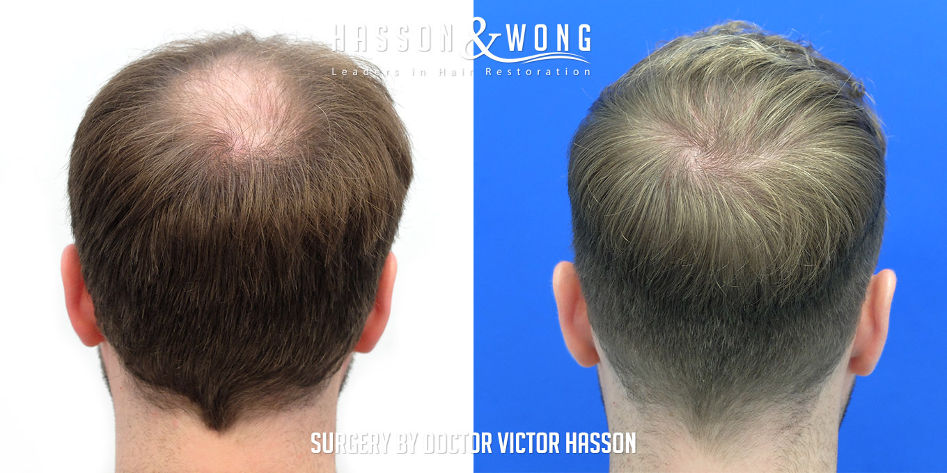 hair-transplant-surgery-before-after-588