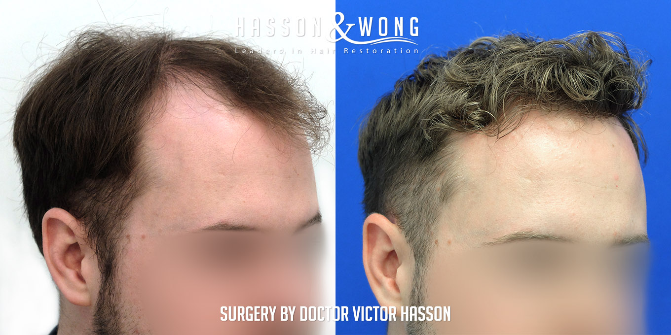hair-transplant-surgery-before-after-588