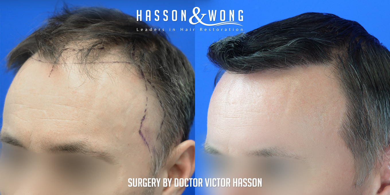 hair-restoration-surgery-before-after-43