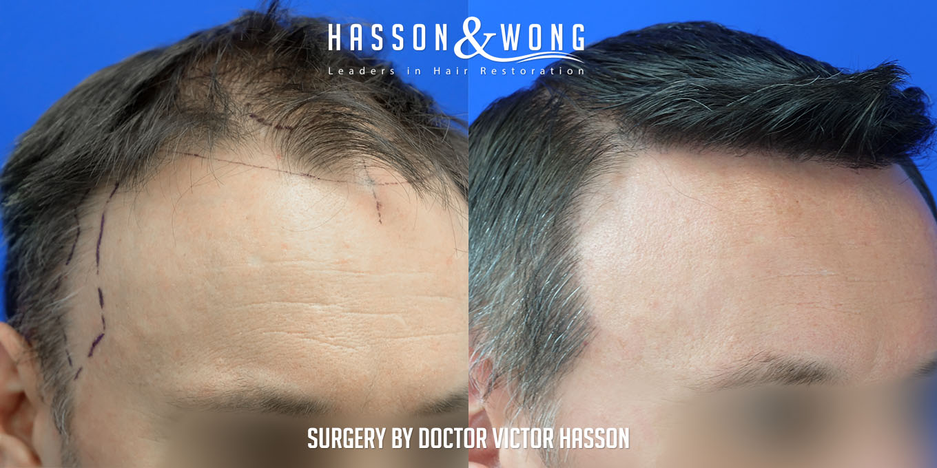 hair-restoration-surgery-before-after-43