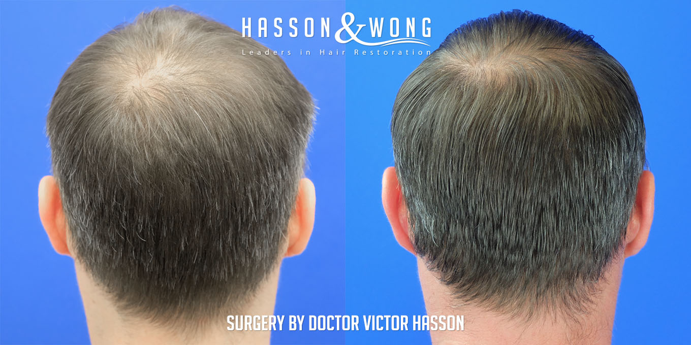 hair-transplant-surgery-before-after-430