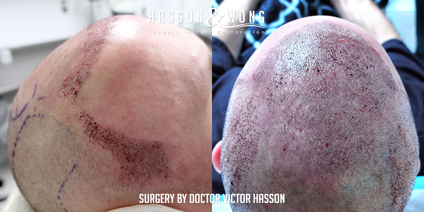 hair-transplant-surgery-before-after-430