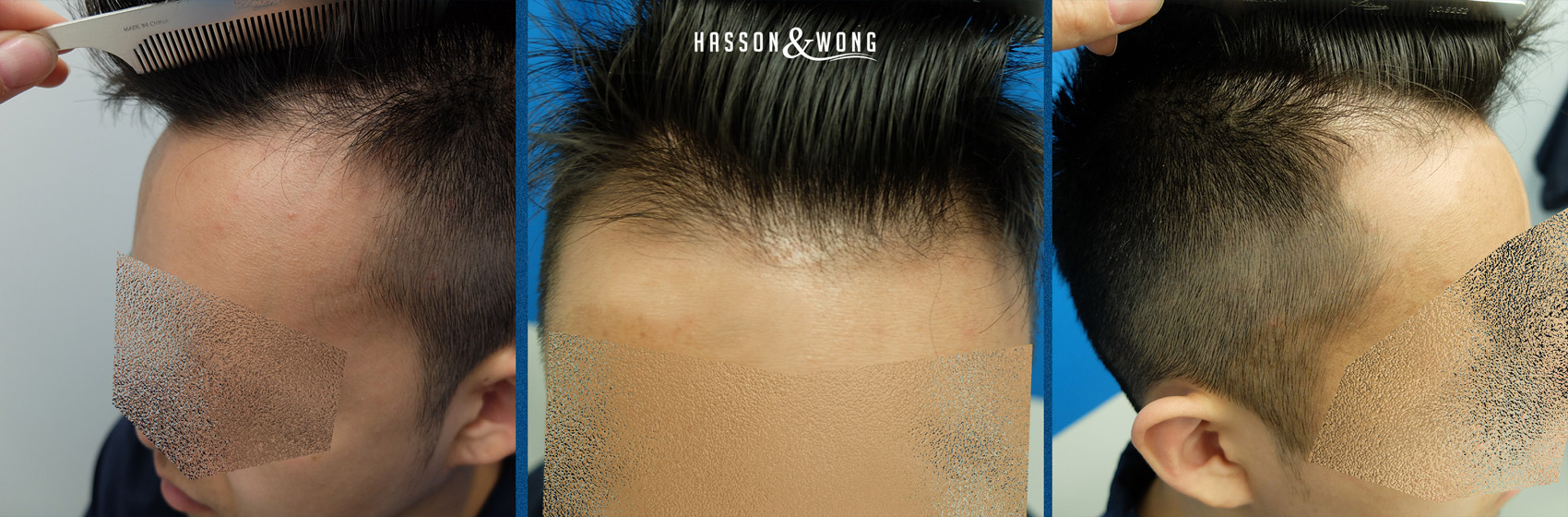 FUE-Hair-Transplant-1.jpg