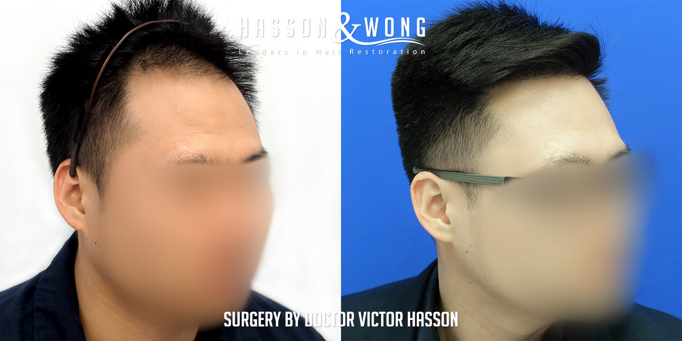 hair-restoration-surgery-before-after-25