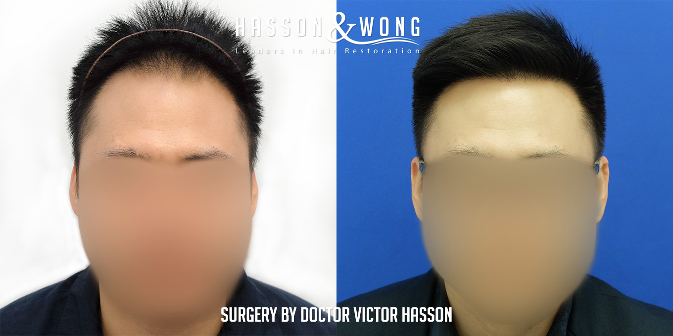 hair-transplant-before-after-2575-grafts
