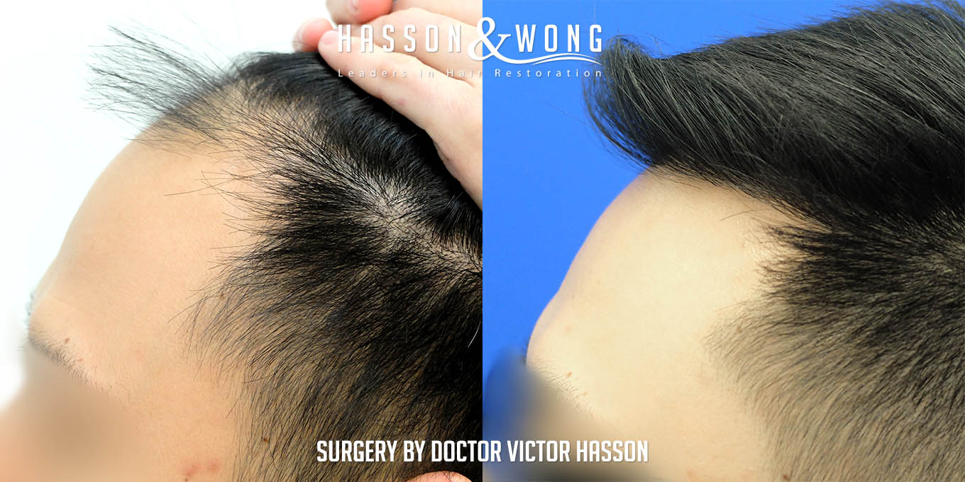 hair-transplant-surgery-before-after-257