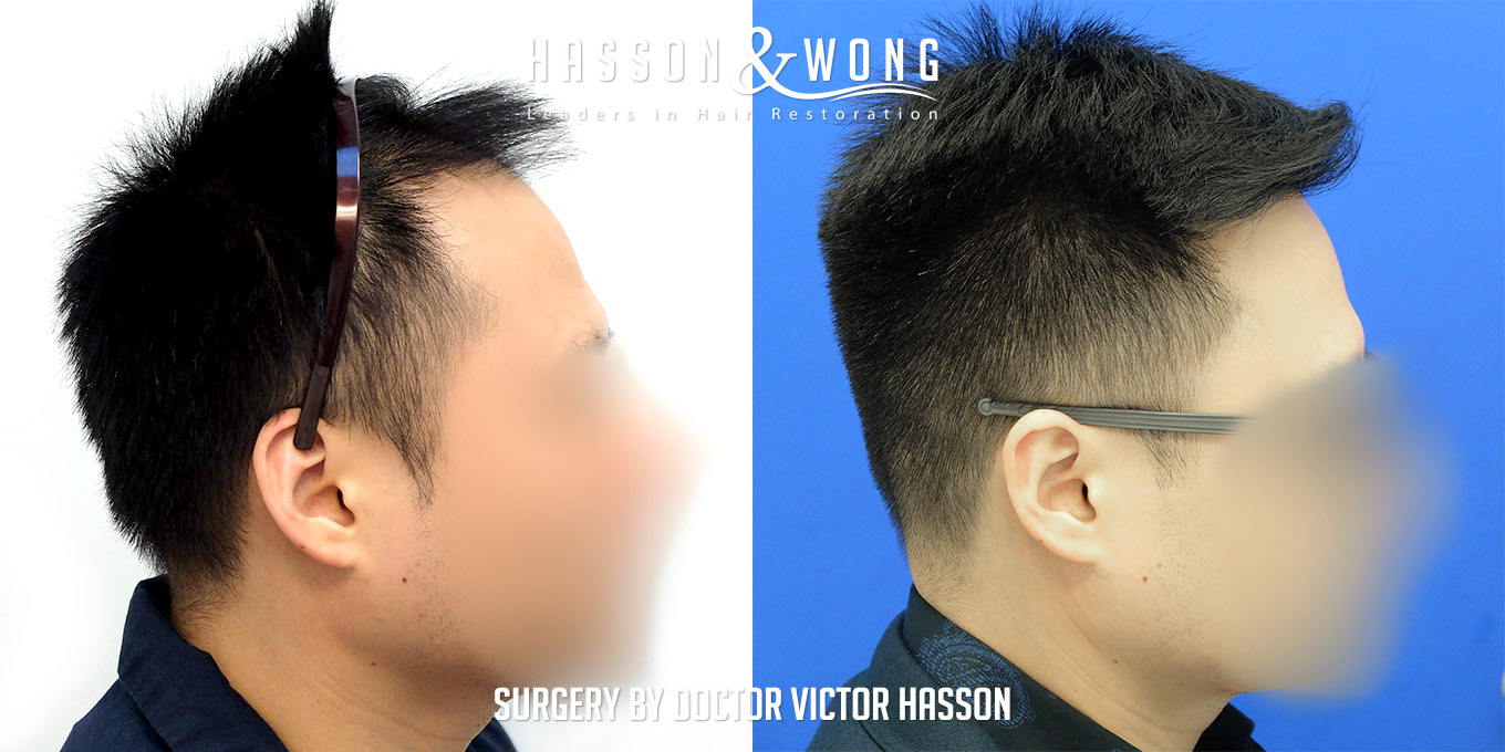 hair-transplant-surgery-before-after-257
