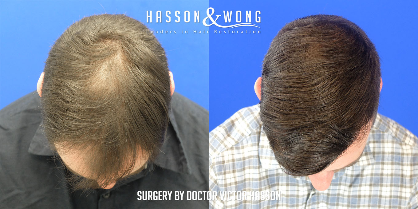 hair-transplant-surgery-before-after-300