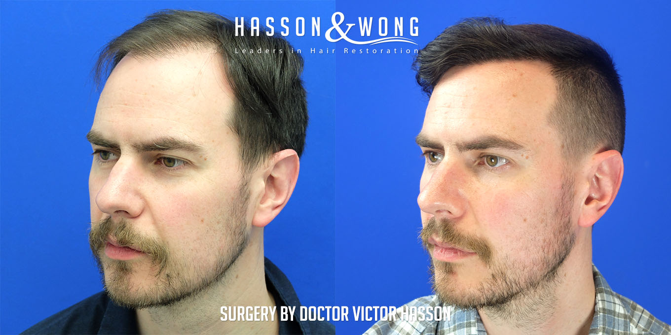 hair-transplant-surgery-before-after-300