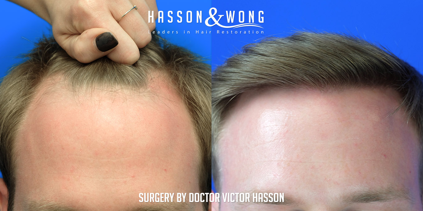 hair-restoration-surgery-before-after-38