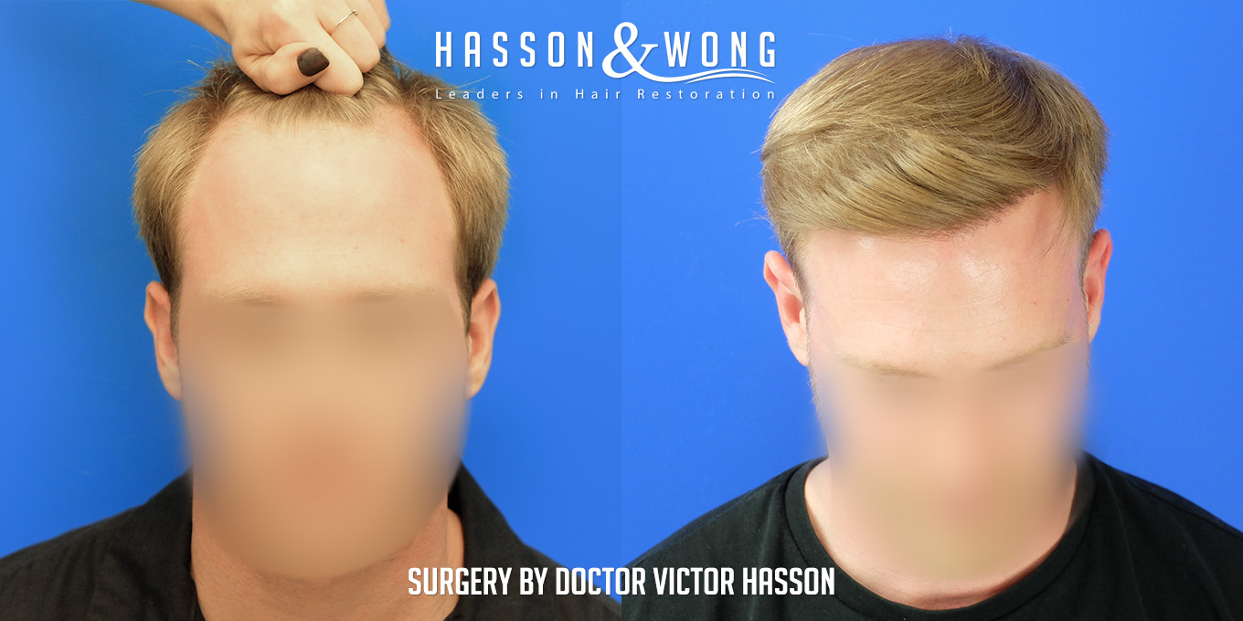 hair-restoration-surgery-before-after-38