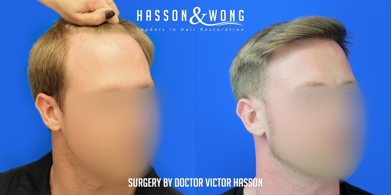 hair-transplant-surgery-before-after-389