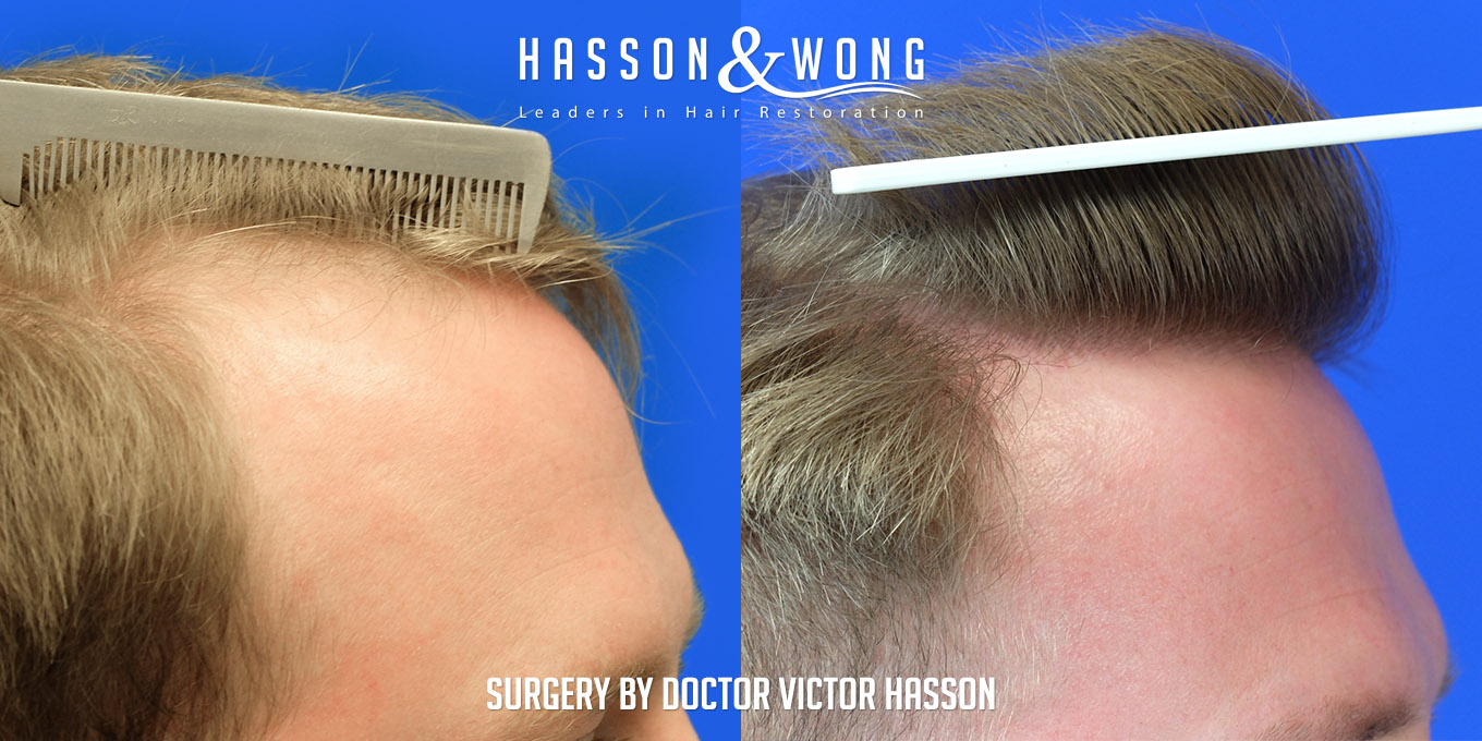 hair-transplant-surgery-before-after-389