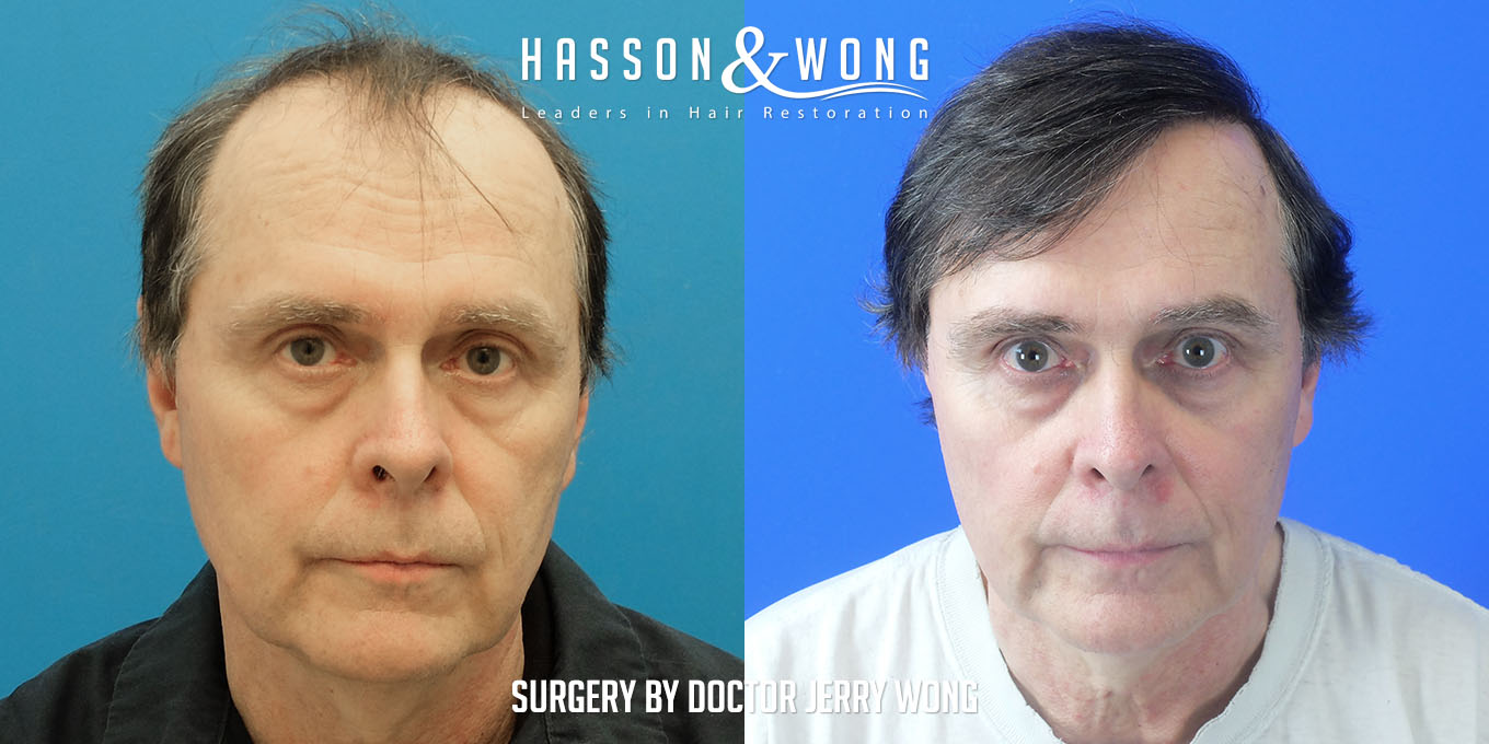 js-drw-fut-hair-transplant-6301-grafts-front-before-after.jpg