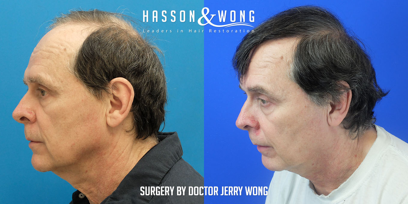 js-drw-fut-hair-transplant-6301-grafts-left-before-after.jpg