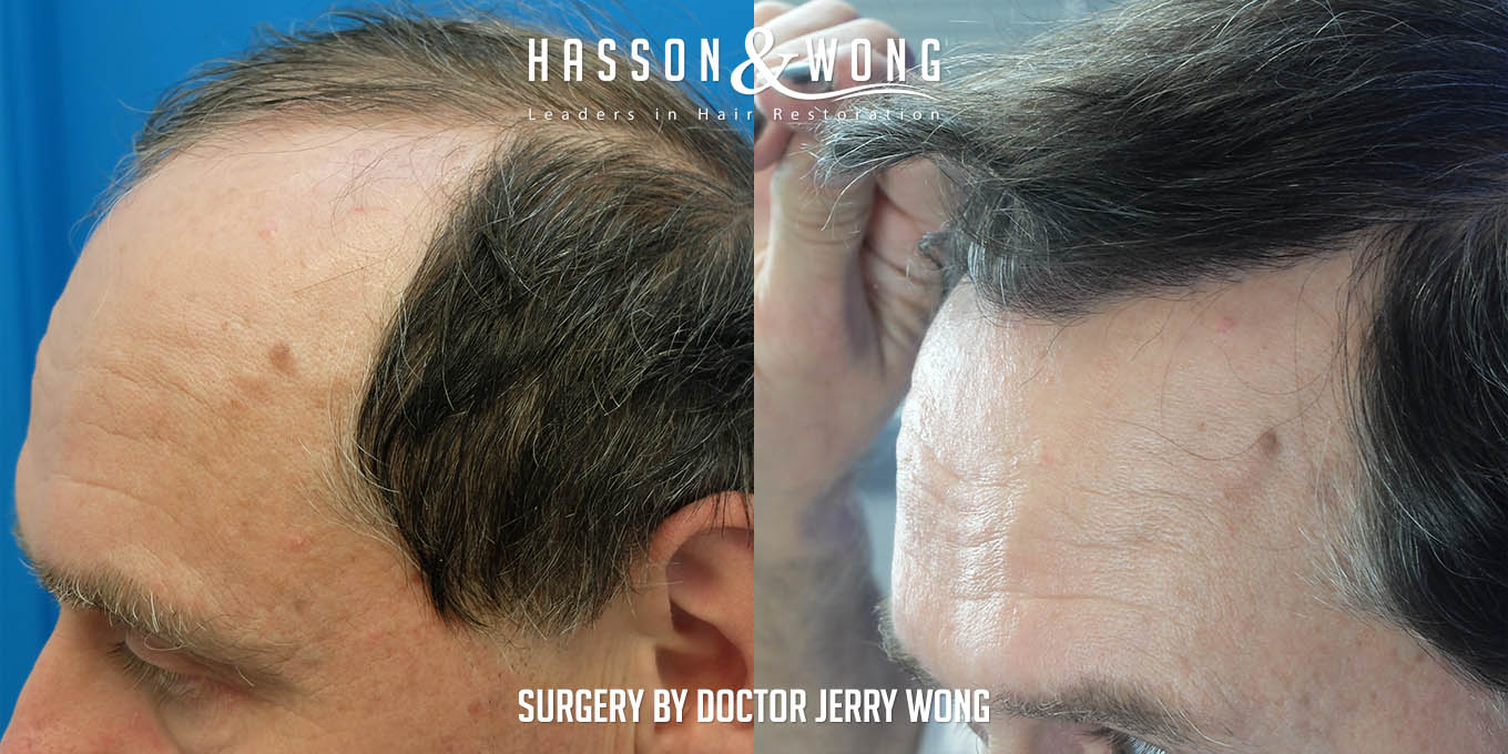 js-drw-fut-hair-transplant-6301-grafts-left-close-before-after.jpg