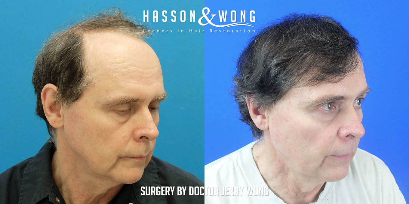 js-drw-fut-hair-transplant-6301-grafts-right-before-after.jpg